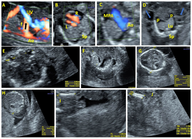 Dr. Anda Ungureanu – Medic Cardiolog Craiova | Articol Științific - Prenatal Diagnosis and Prognosis of Abdominal Arteriovenous Fistulae: A Comprehensive Case Series and Systematic Review